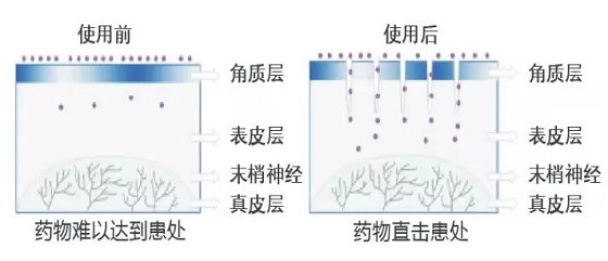 【脫發(fā)不可小覷 域發(fā)微針來啦】黃驊市人民醫(yī)院皮膚科開展域發(fā)微針生發(fā)技術(shù)